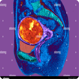 MR guided HIFU/LIFU
