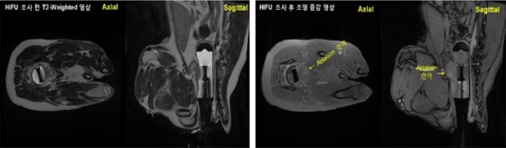 MR guided HIFU/LIFU