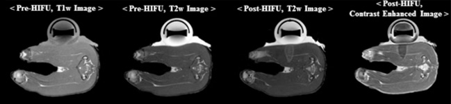 MR guided HIFU/LIFU