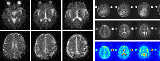 7.0T MRI